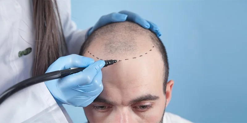 hair transplant in Turkey