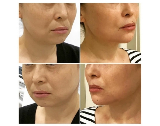 konturnaya plastika litsa