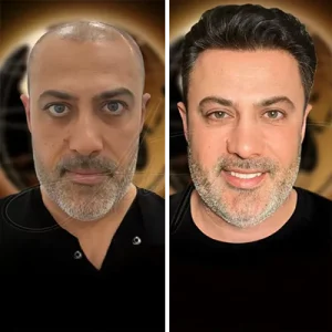 Hair Transplant Turkey Price (Cost) 2 Hair transplant in Istanbul